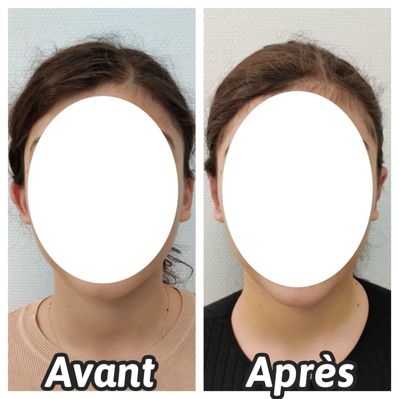 otoplastie